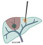 kombiniertes Vorgehen - Ablation und Leberresektion