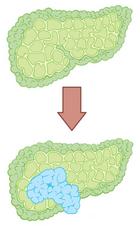 Tumeurs du foie (carcinome hépatocellulaire)