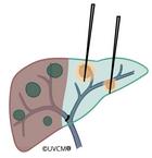 zweizeitiges Vorgehen: Initiale Ablation gefolgt von einer Leberresektion zu einem späteren Zeitpunkt